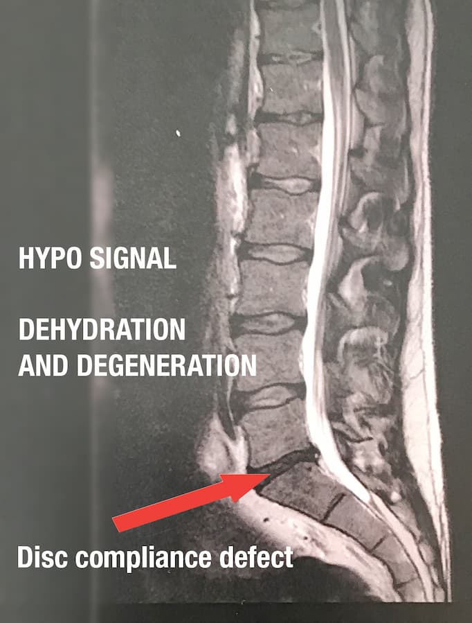 MRI of lumbar region